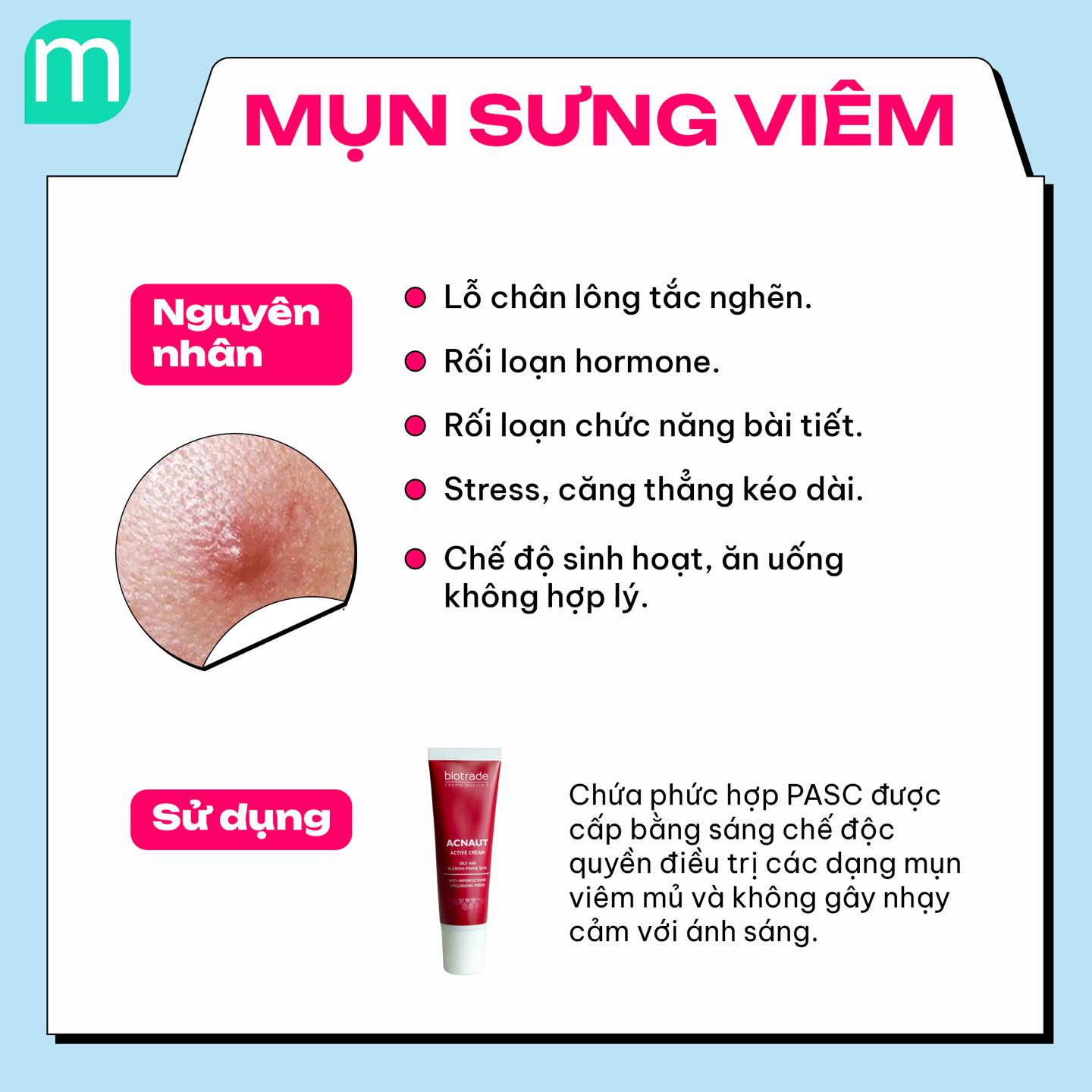 4 dạng mụn phổ biến và cách xử lý cơ bản