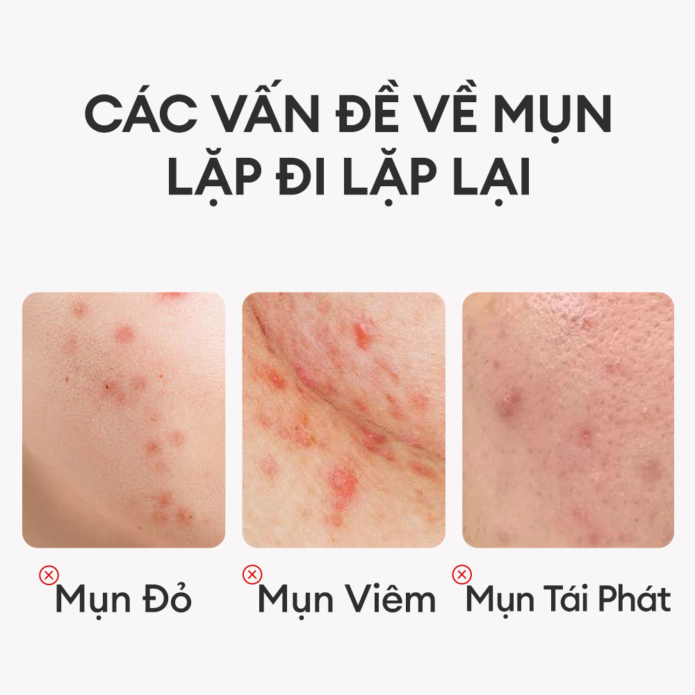 Kem Trị Mụn Colorkey Luminous Green Tea Purifying Acne Treatment 20g Kem Trị Mụn Colorkey Luminous Green Tea Purifying Acne Treatment 20g
