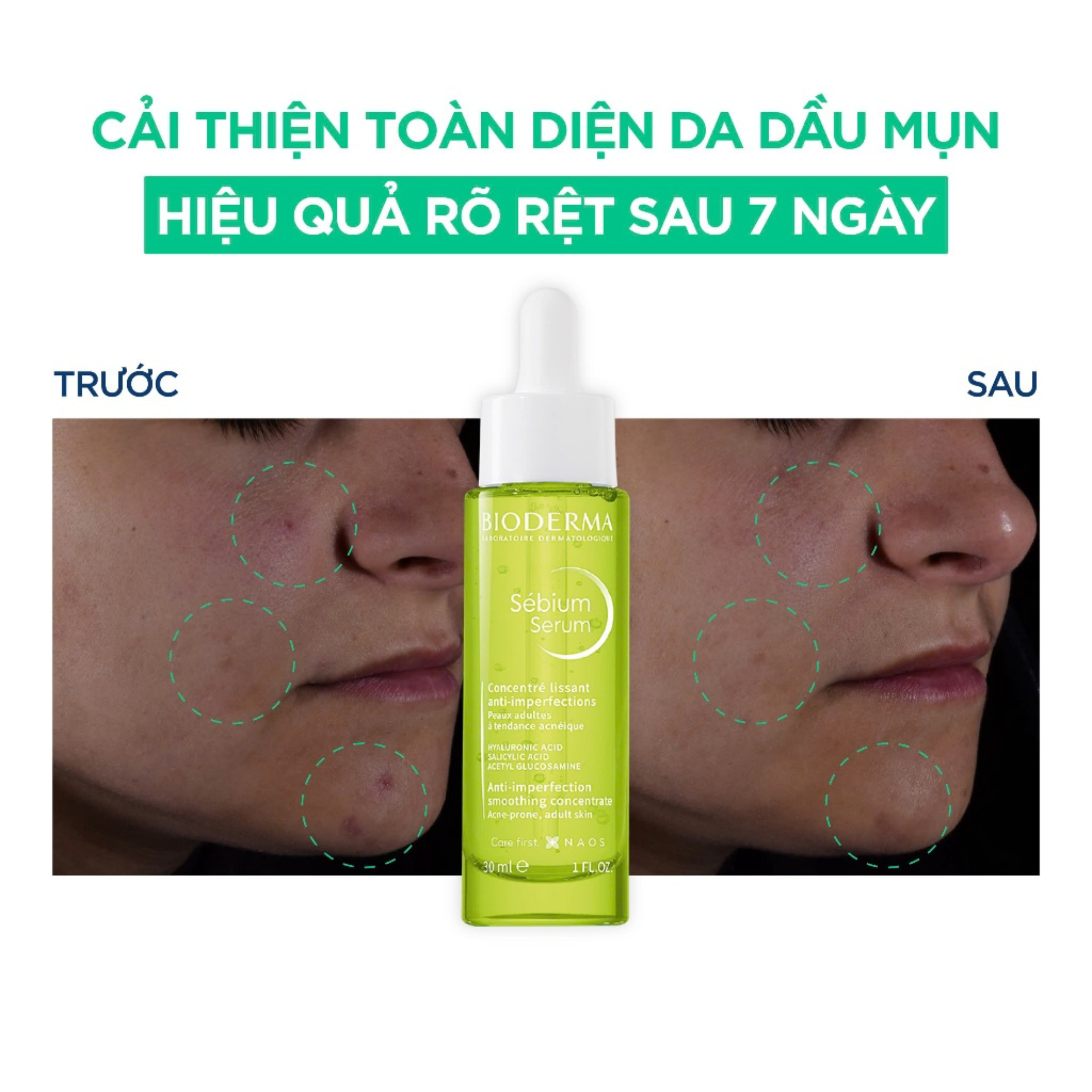 Tinh Chất Sáng Da Mờ Thâm Bioderma Sébium Serum 30ml Tinh Chất Sáng Da Mờ Thâm Bioderma Sébium Serum 30ml
