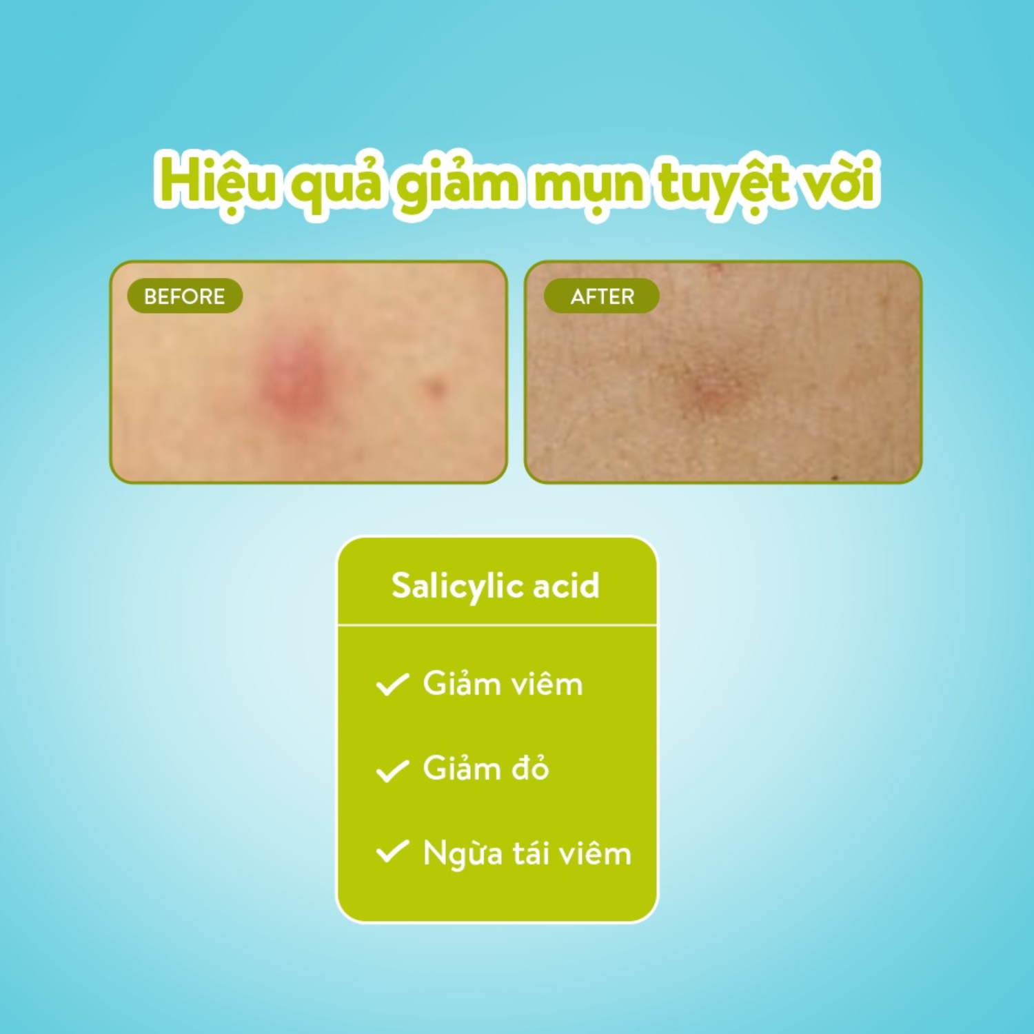Miếng Dán Mụn Derma Angel Acne Patch Plus 12 Miếng Miếng Dán Mụn Derma Angel Acne Patch Plus 12 Miếng