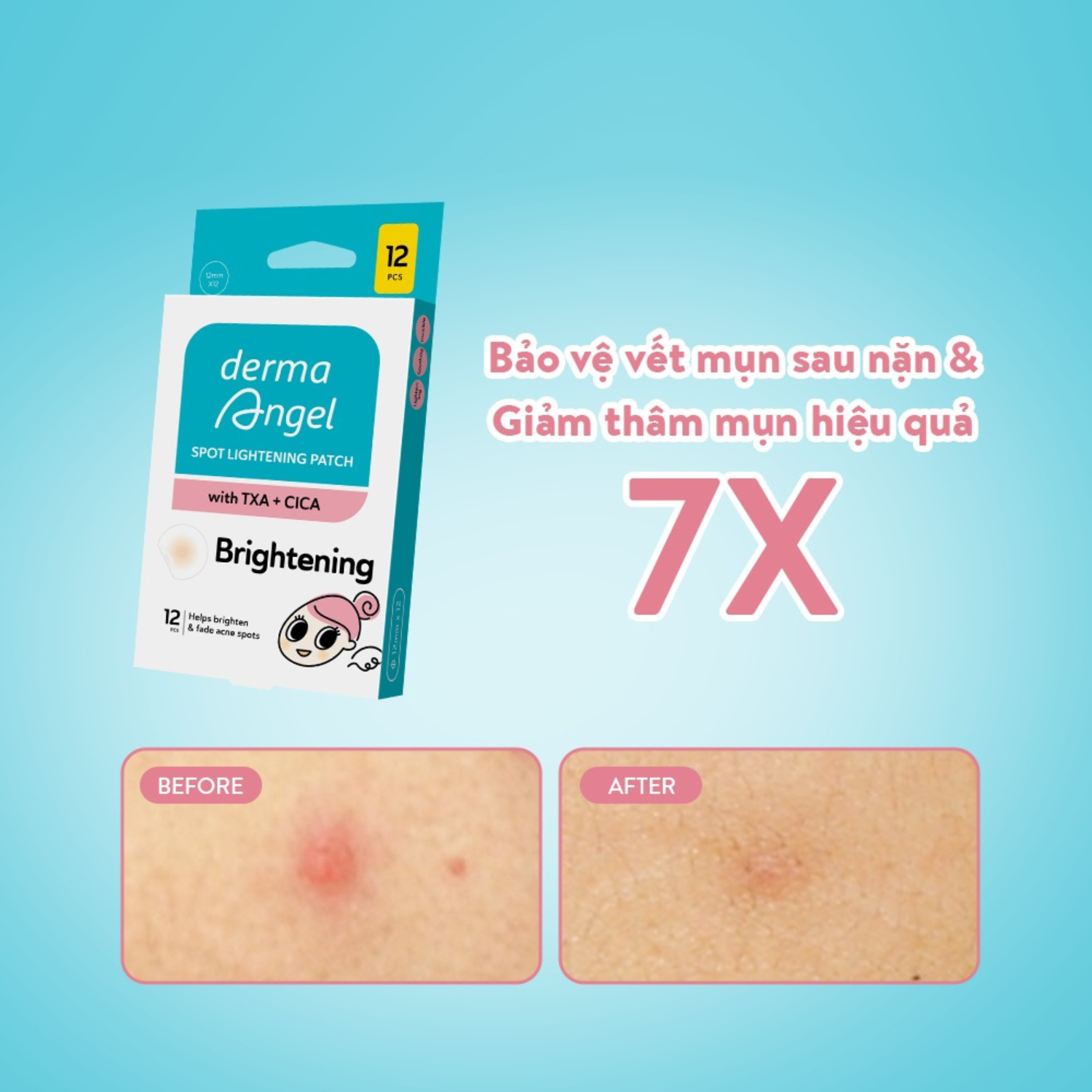 Miếng Dán Mụn Derma Angel Spot Lightening Patch 12 Miếng Miếng Dán Mụn Derma Angel Spot Lightening Patch 12 Miếng